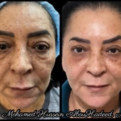 Bio-stimulatory power of CaHA (Calcium Hydroxylapatite).