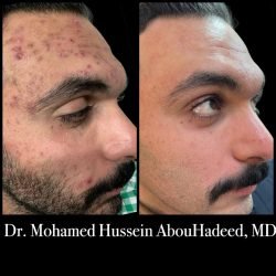 ACNE, post acne spots and scars