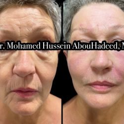 the power of injectables